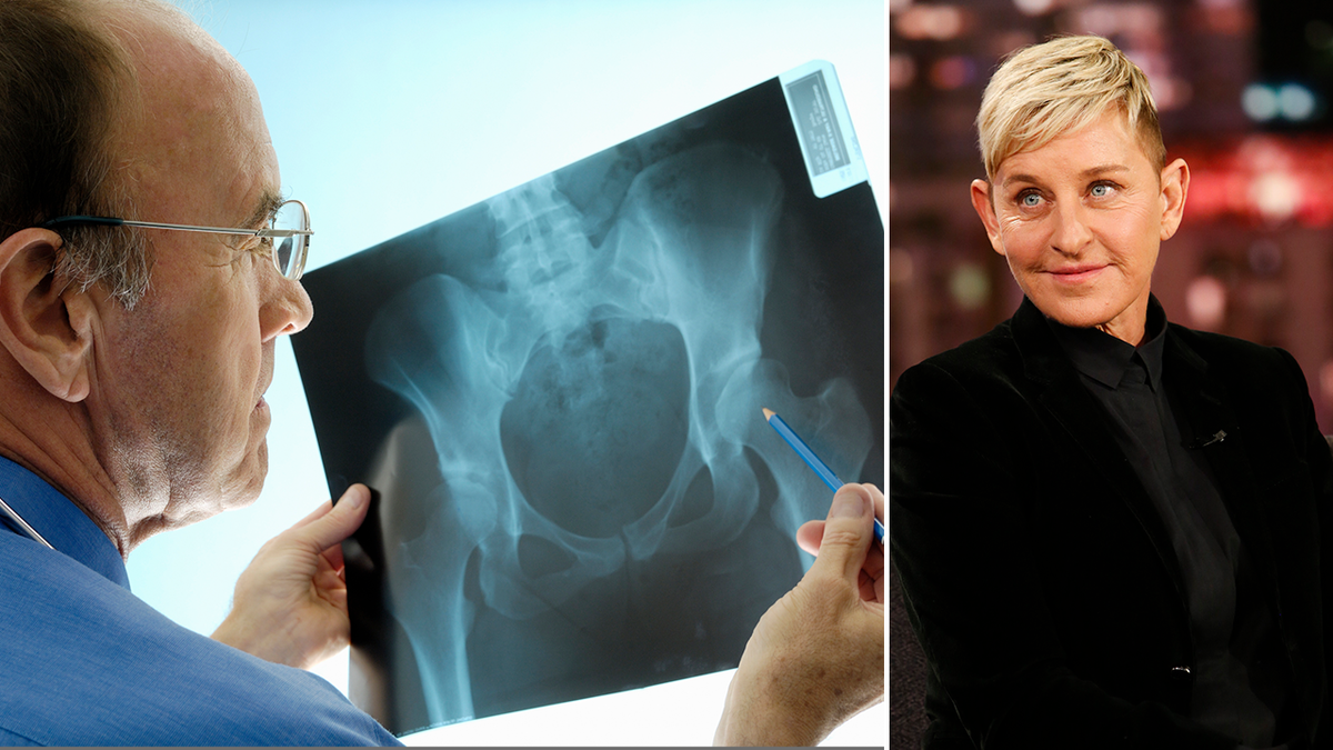 split image of an x-ray of a hip and Ellen DeGeneres