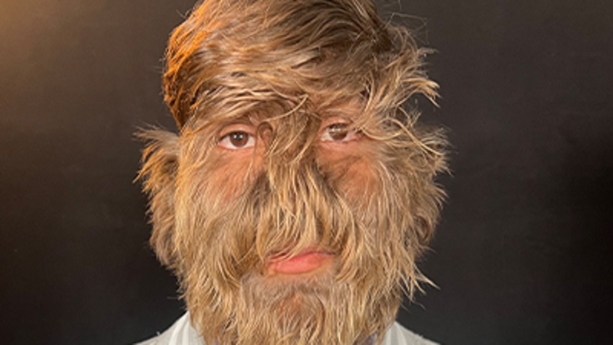 Lalit Patidar - Werewolf syndrome