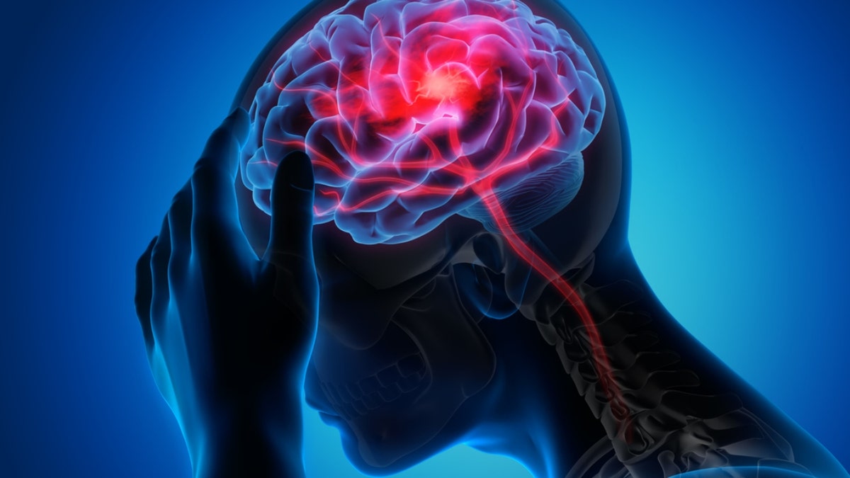 stroke in the brain graphic