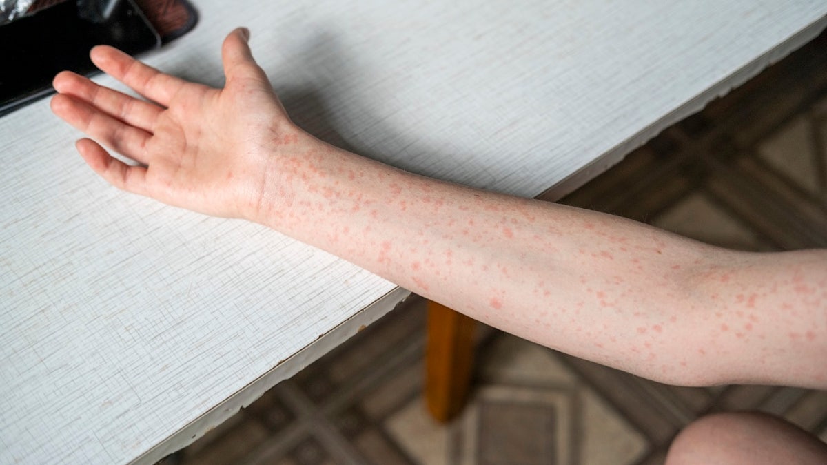 arm with measles